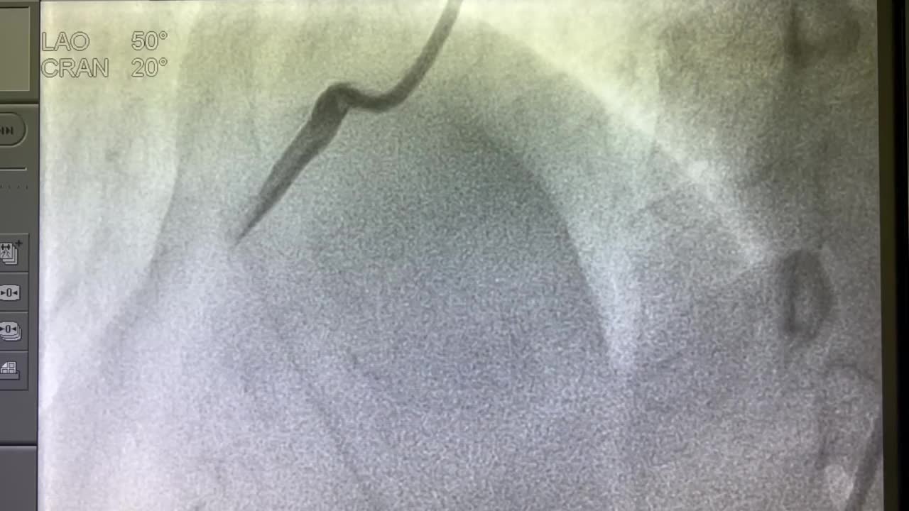 冠状动脉造影视频下载