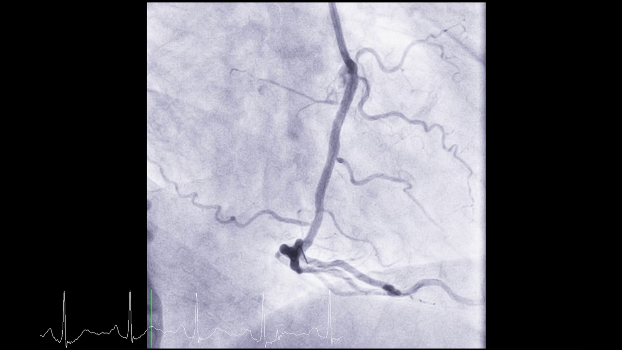 心脏导管显示冠状动脉诊断心脏骤停。视频素材