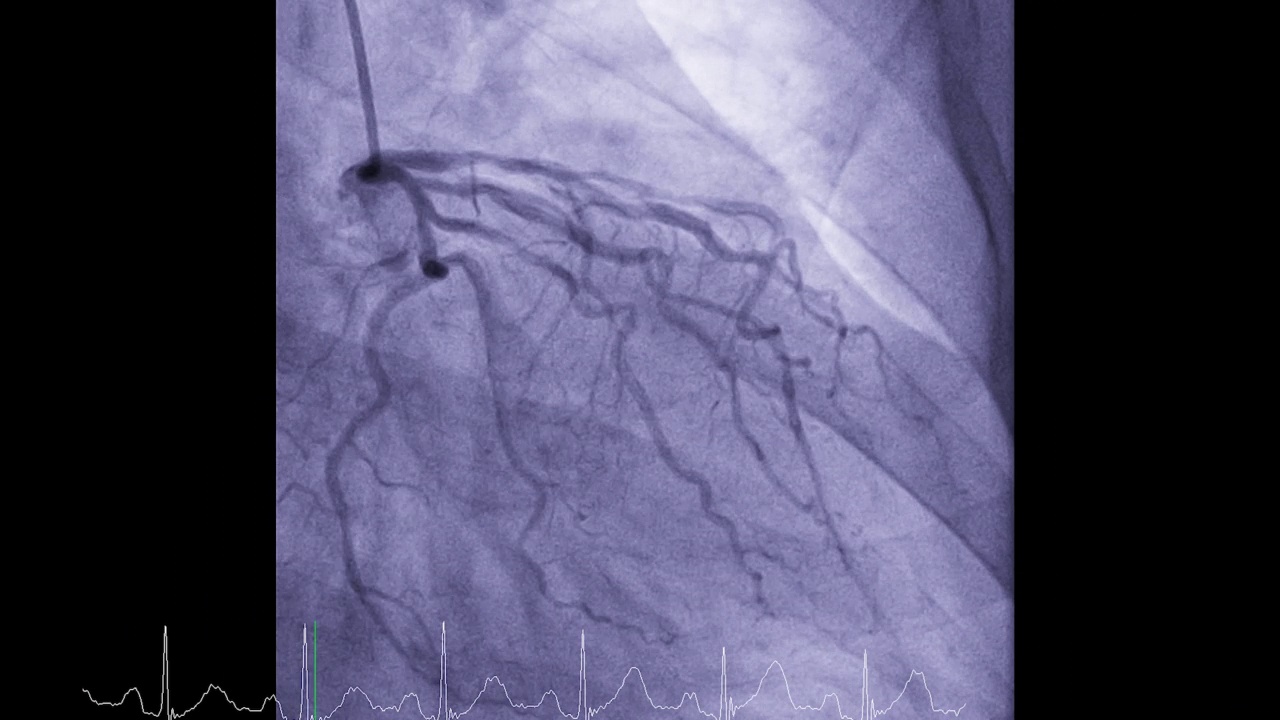 心脏导管显示冠状动脉诊断心脏骤停。视频素材