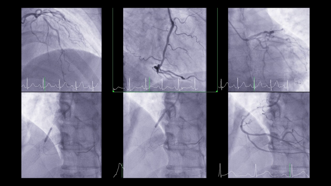 心脏导管显示冠状动脉诊断心脏骤停。视频素材