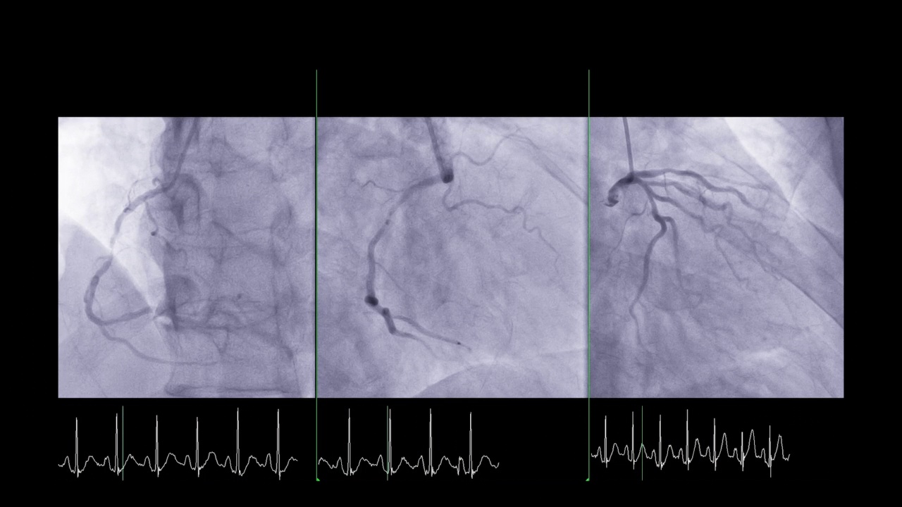 心脏导管显示冠状动脉诊断心脏骤停。视频素材