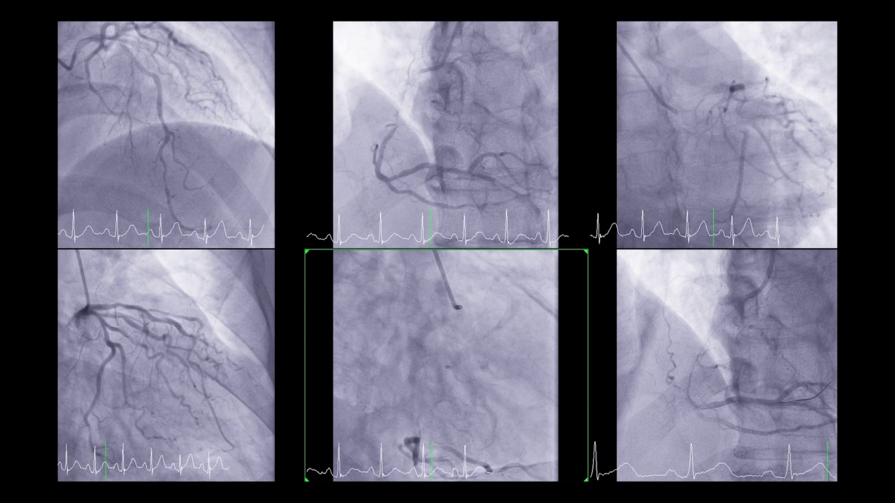 心脏导管显示冠状动脉诊断心脏骤停。视频素材