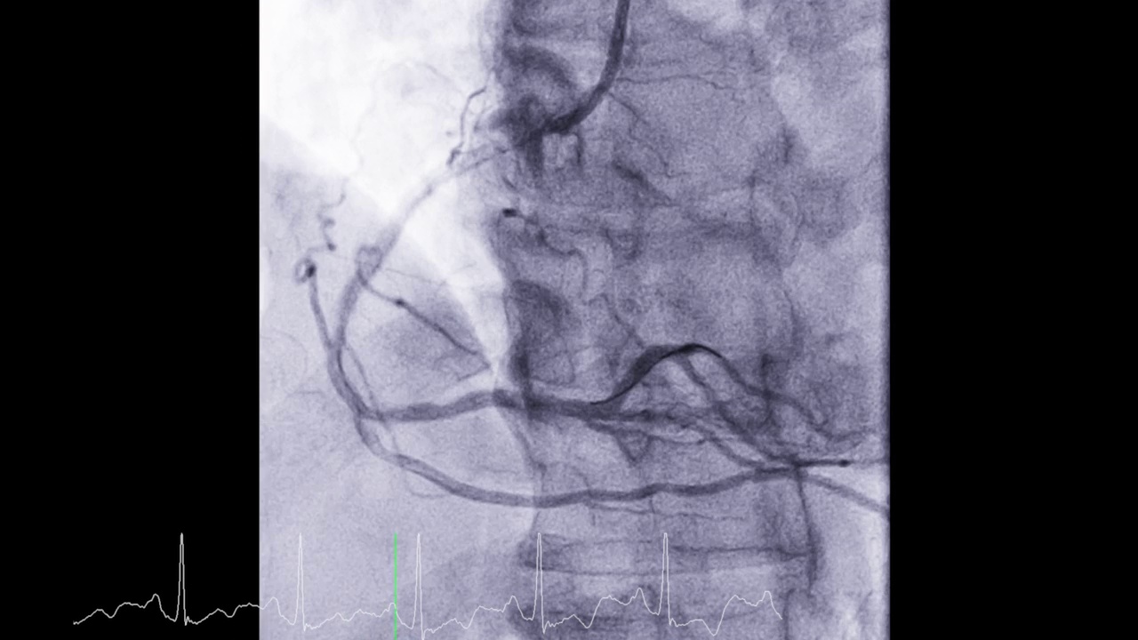 心脏导管显示冠状动脉诊断心脏骤停。视频素材
