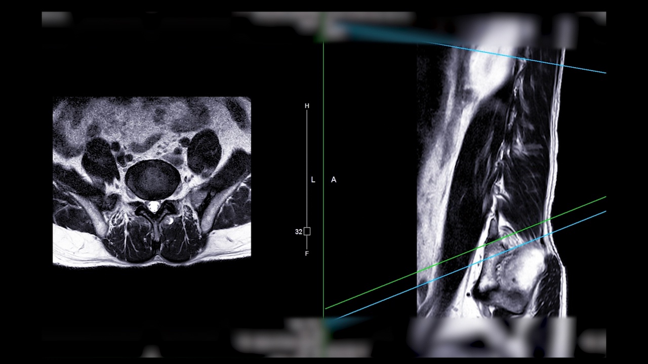 MRI L-S脊柱或腰椎。视频素材