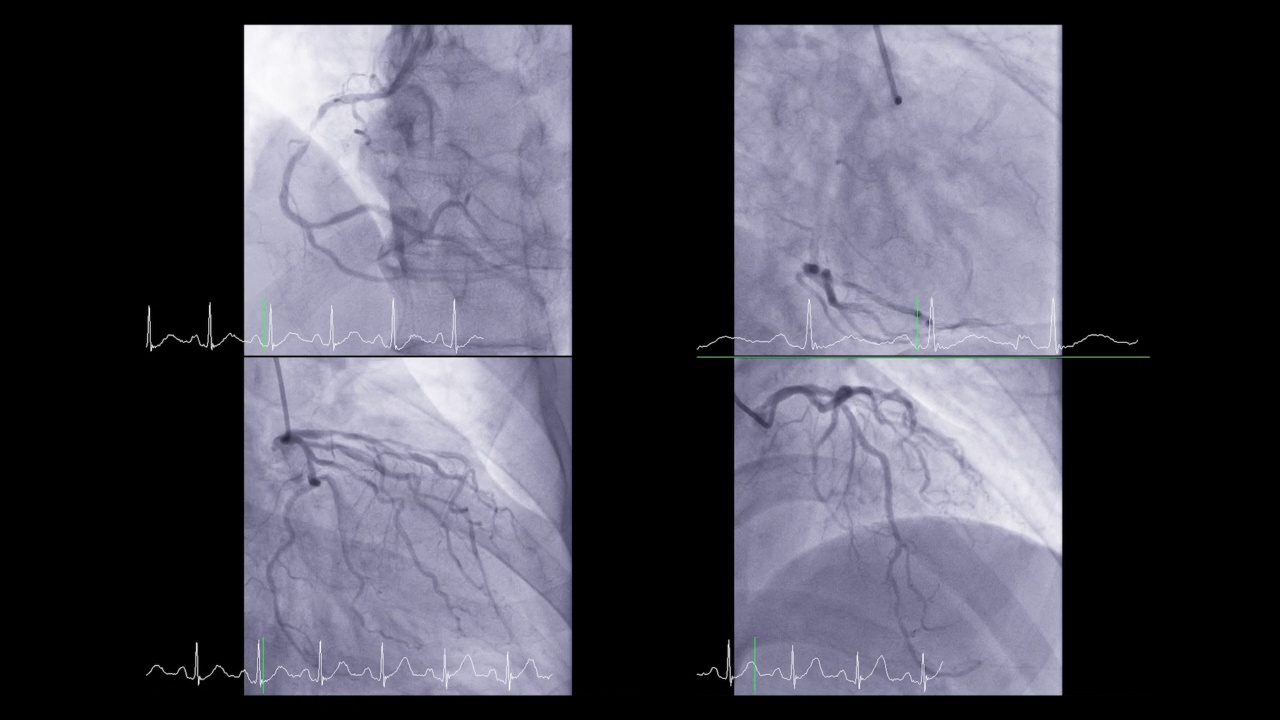 心脏导管显示冠状动脉诊断心脏骤停。视频素材