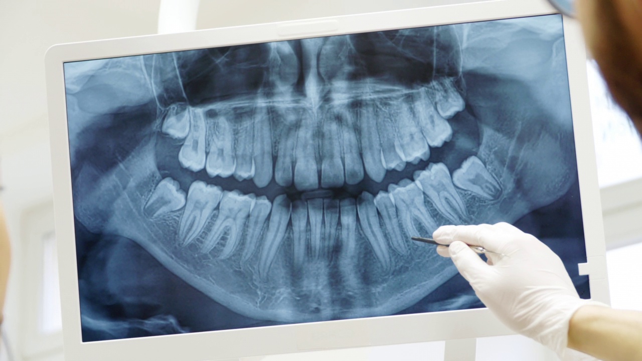 正畸医生在手术过程中显示牙齿x光的特写视频素材
