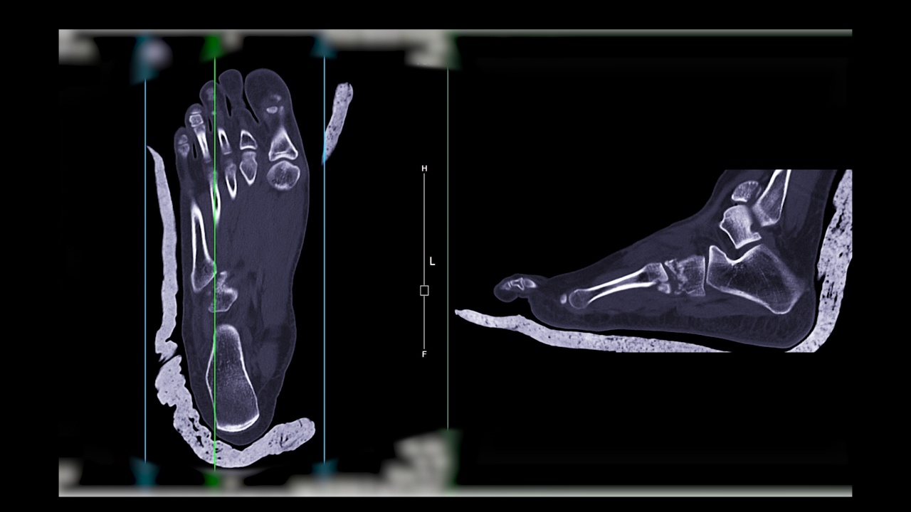 足部CT扫描诊断骨折。视频素材