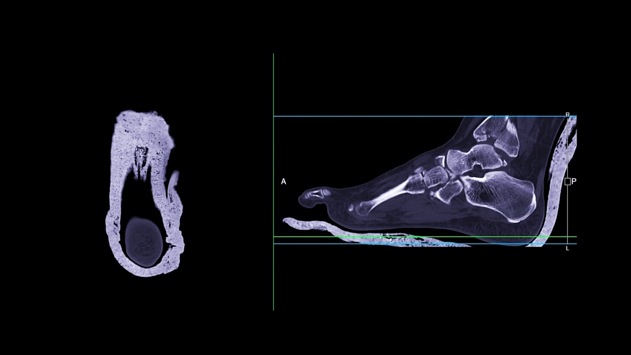 足部CT扫描诊断骨折。视频素材