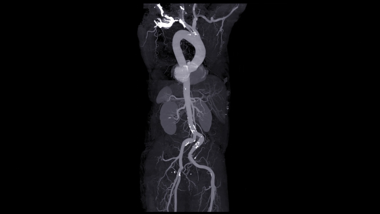 CTA全主动脉三维绘制在屏幕上旋转，用于诊断主动脉夹层或动脉瘤。视频素材