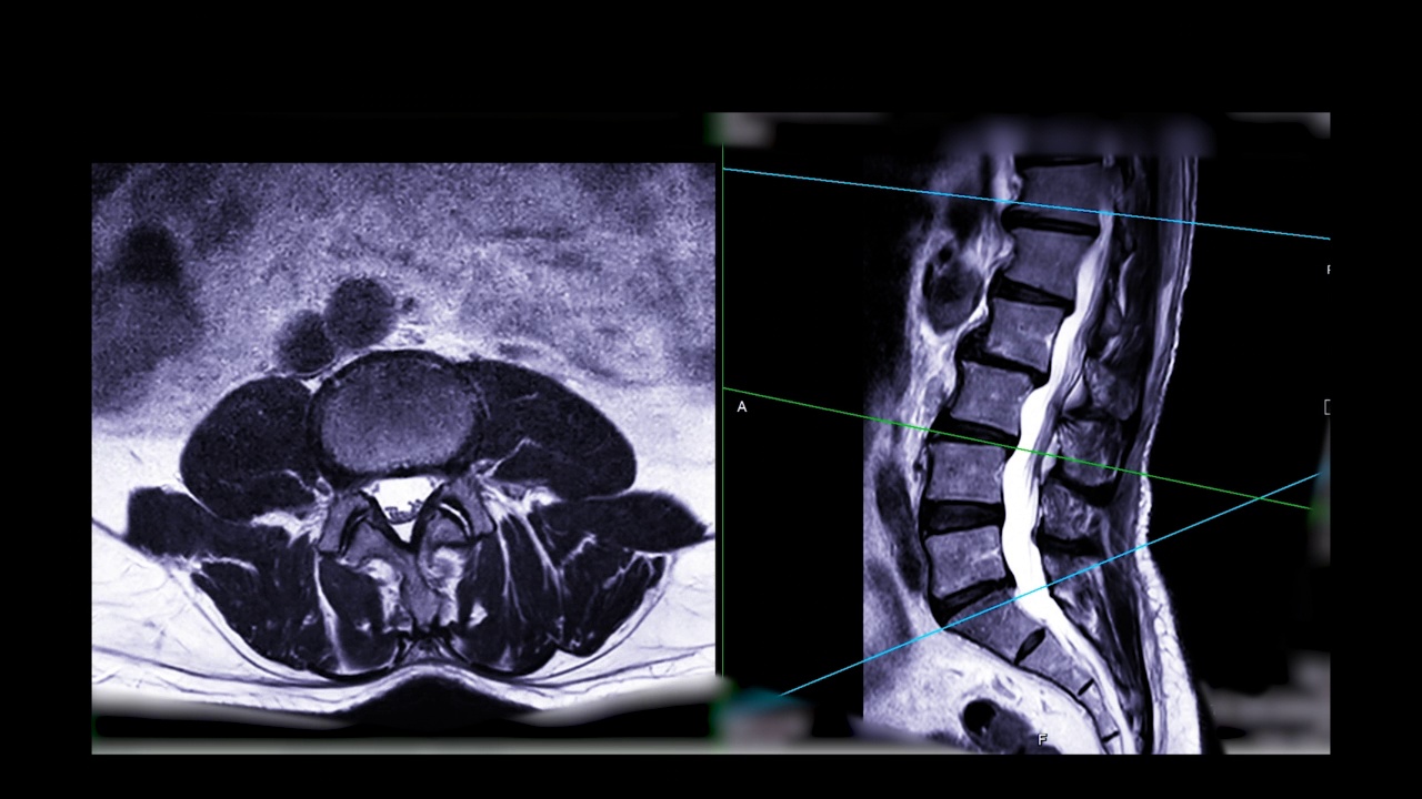 MRI L-S脊柱或腰椎轴位T2W矢状面切面，用于诊断脊髓受压。视频素材