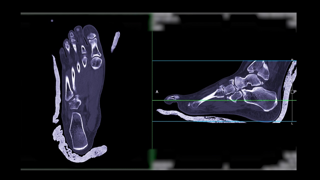 足部冠状位和矢状位CT扫描诊断骨折。视频素材