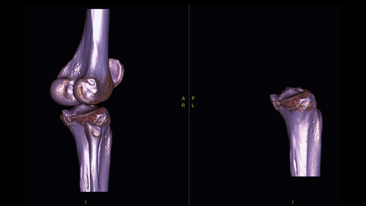 膝关节CT扫描三维绘制。视频素材