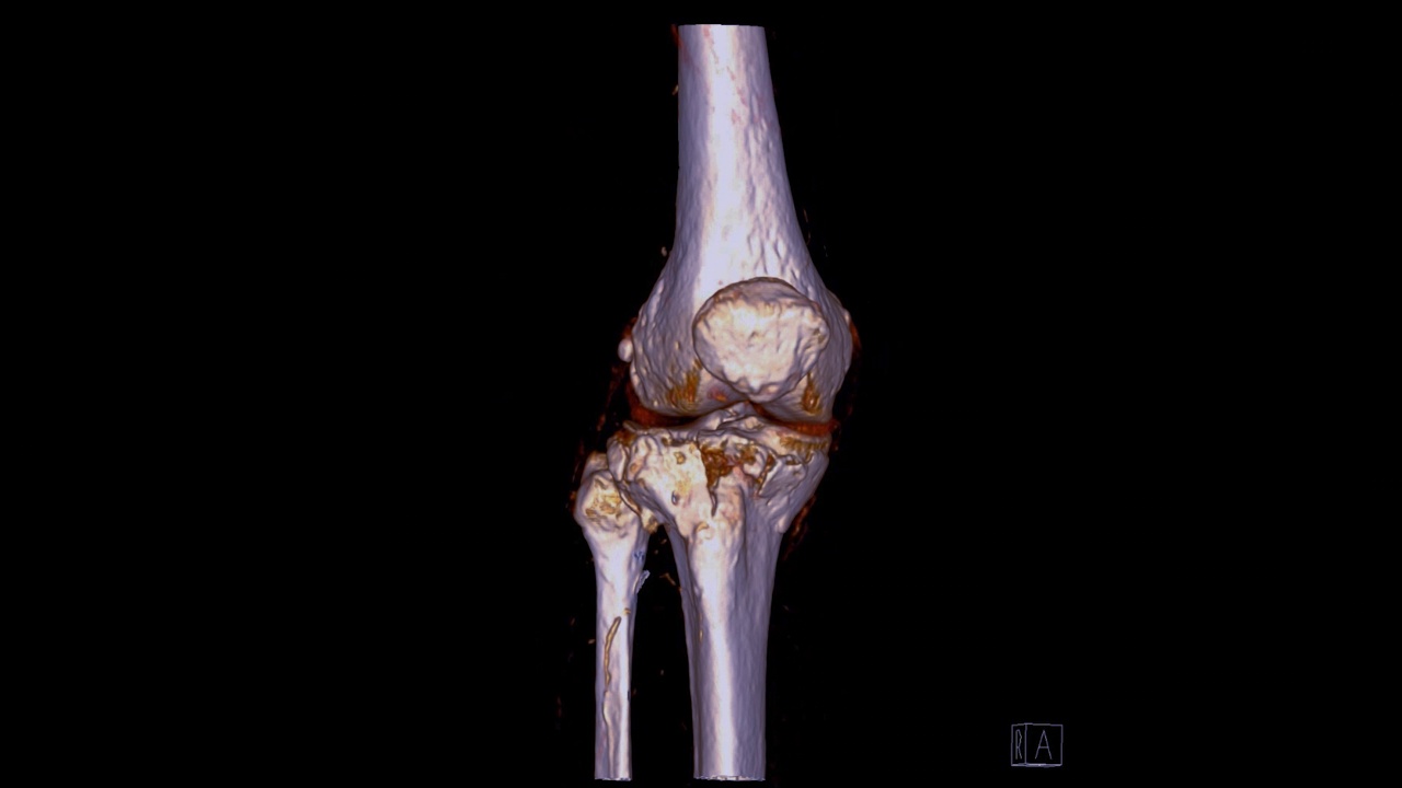 膝关节CT扫描三维绘制。视频素材