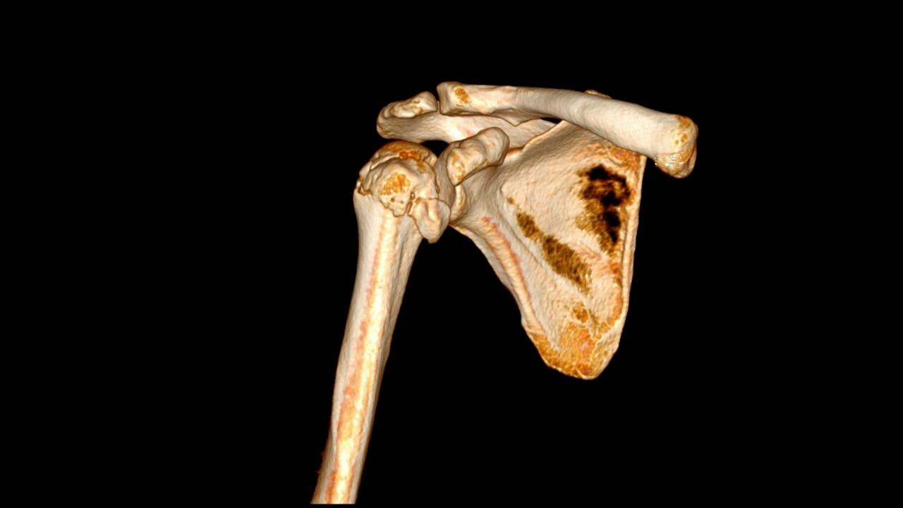 CT扫描肩关节三维绘制图像。视频素材