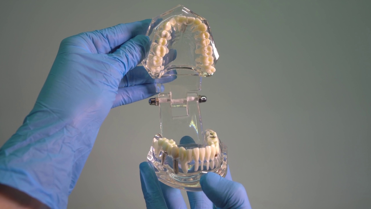在牙医的手中植入的人类下颌模型。牙科植体实验室。视频素材