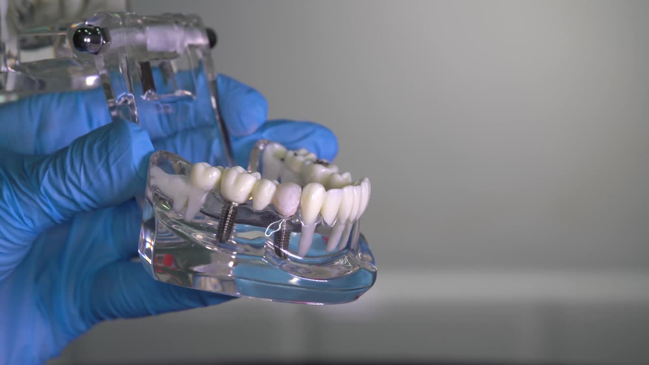 在牙医的手中植入的人类下颌模型。牙科植体实验室。视频素材