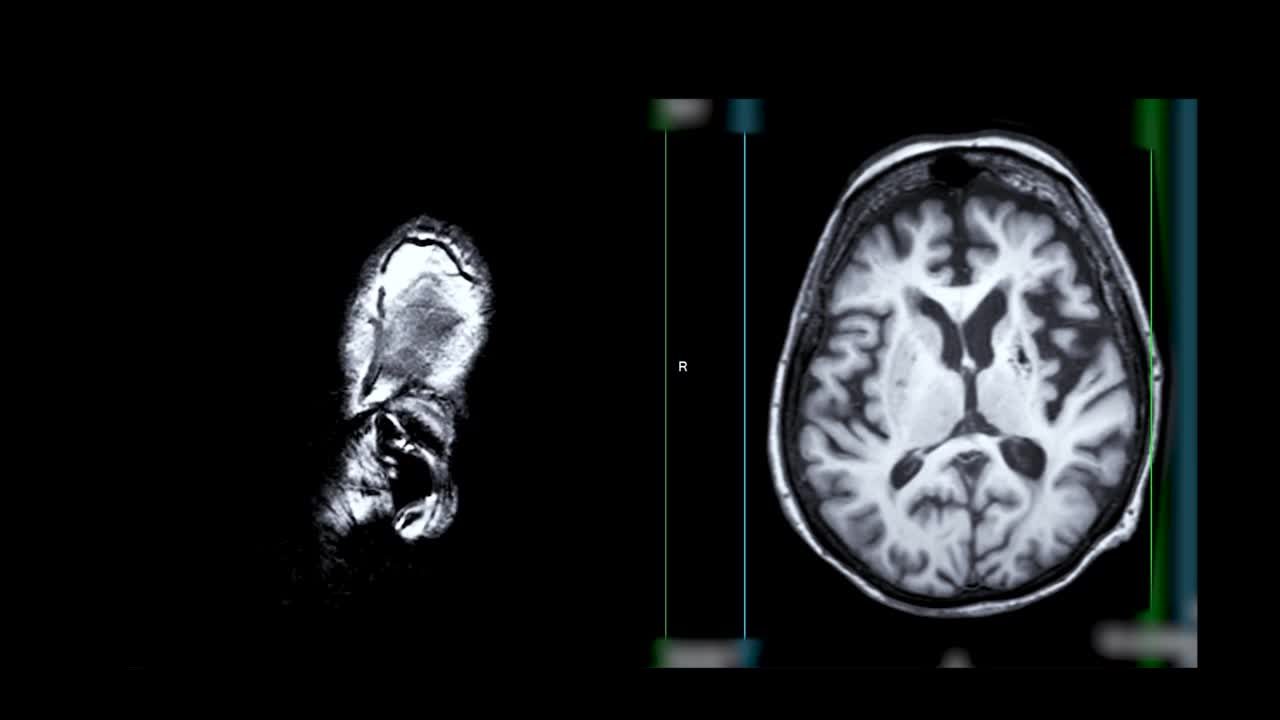 大脑核磁共振成像。视频素材