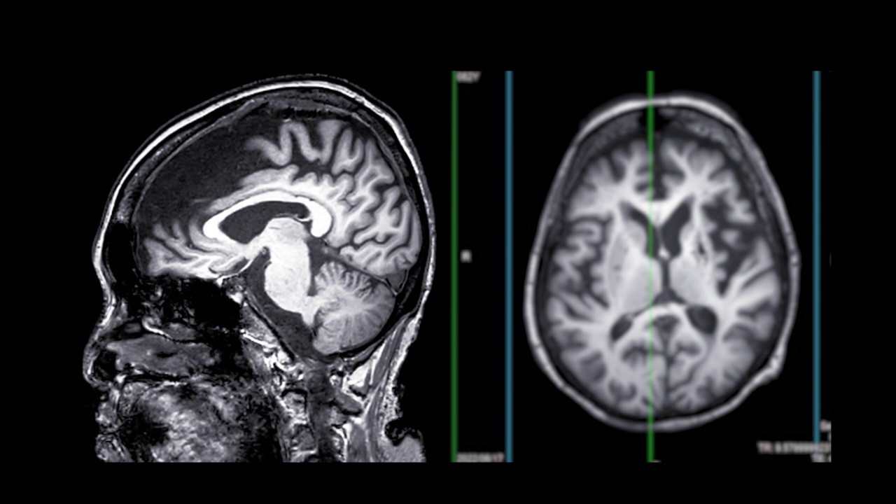 大脑核磁共振成像。视频素材