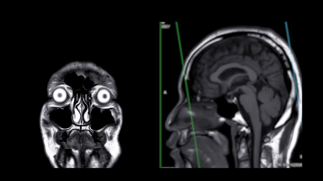 大脑核磁共振成像。视频素材
