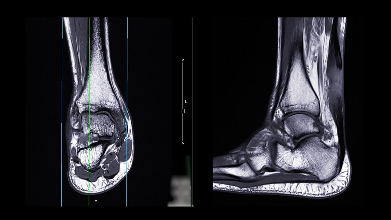 踝关节核磁共振。视频素材