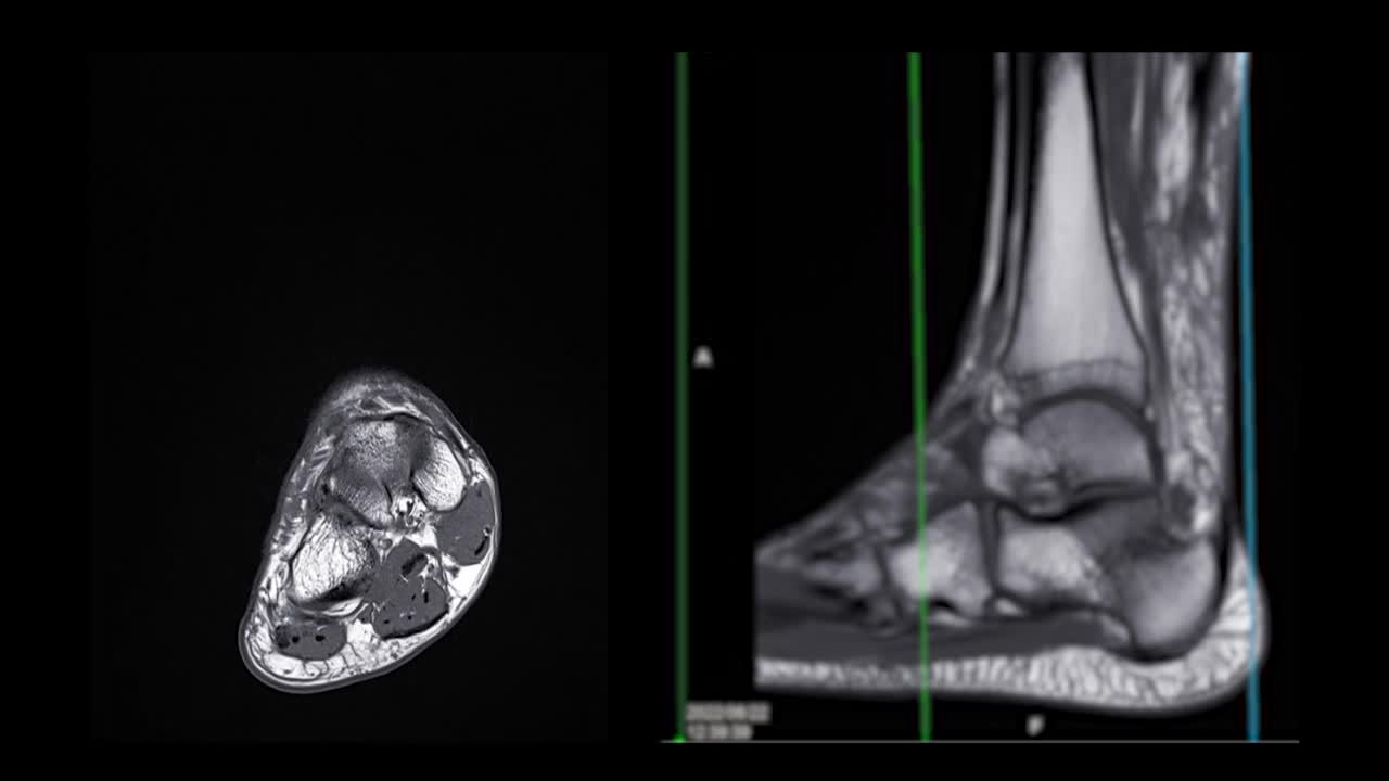 踝关节核磁共振。视频素材