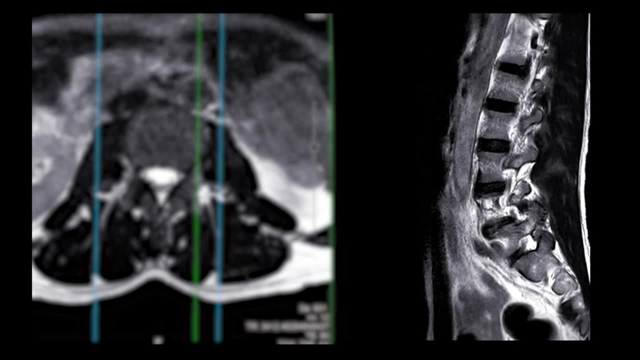 核磁共振成像条件下脊柱。视频素材