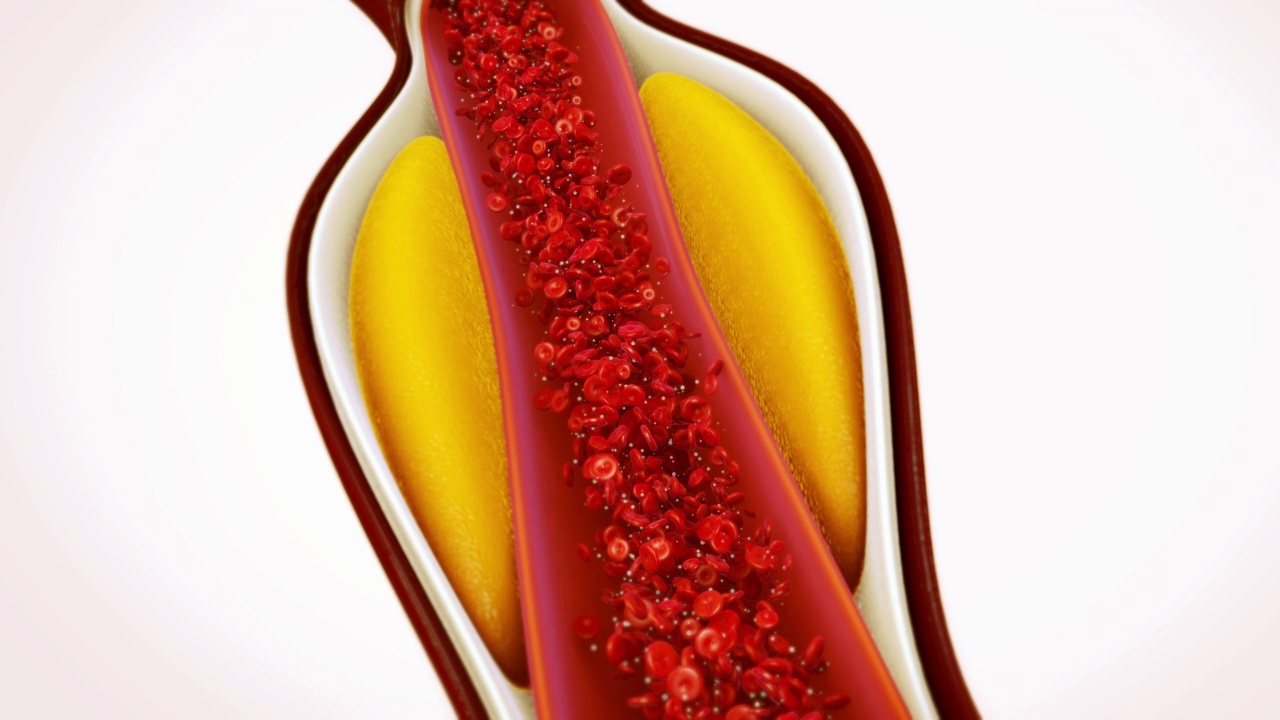 脂肪卡在血液动脉中的胆固醇视频素材
