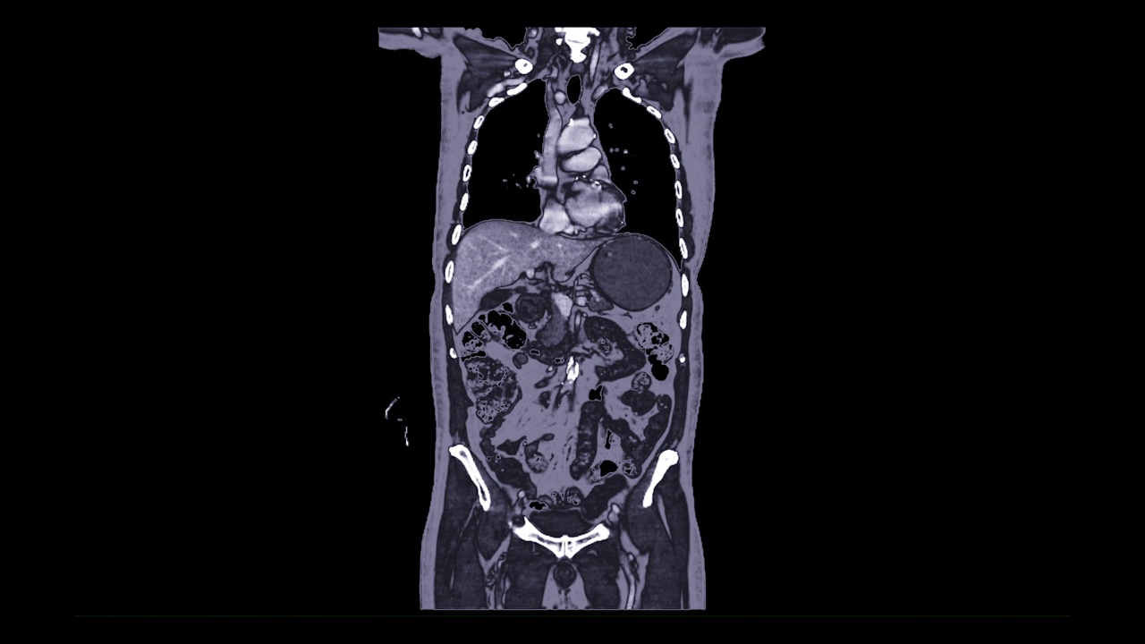 CT胸腹部视频素材