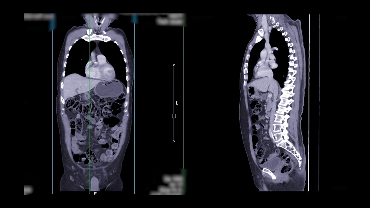 CT胸腹部视频素材