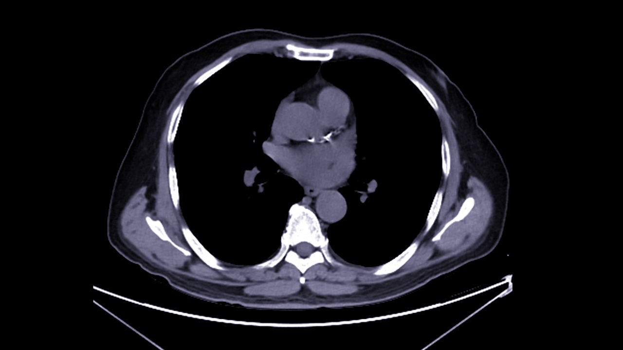 CT胸腹部视频素材