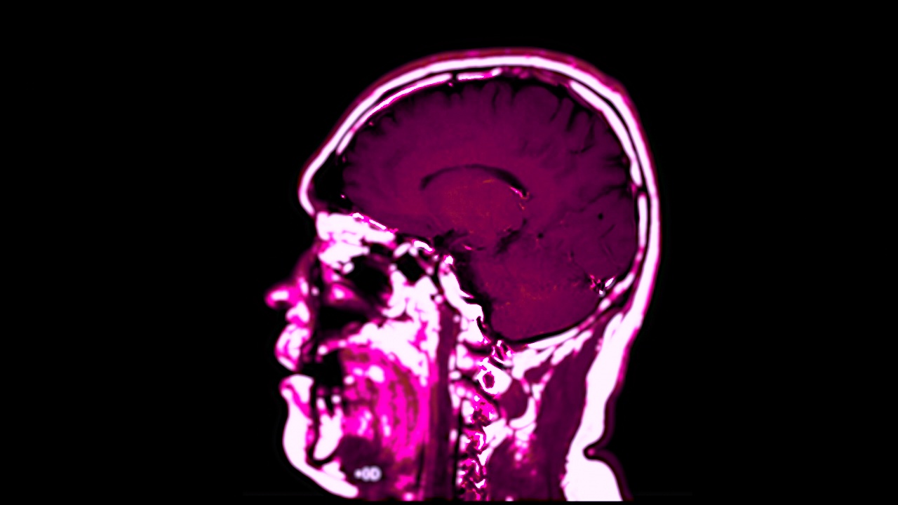 大脑矢状面MRI。视频素材