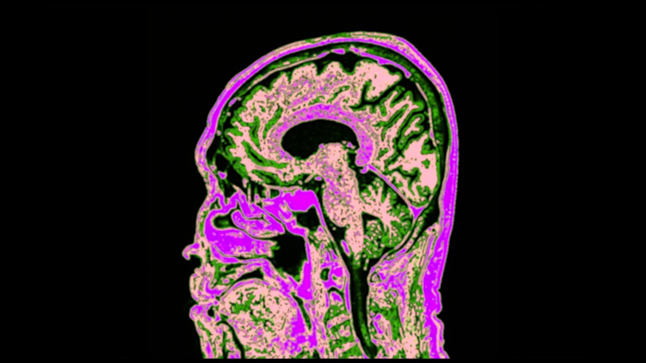 大脑矢状面MRI。视频素材