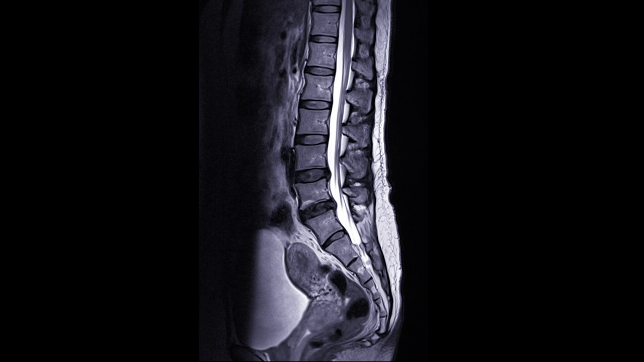 MRI L-S脊柱或腰椎矢状面T2W技术诊断脊髓压迫视频素材