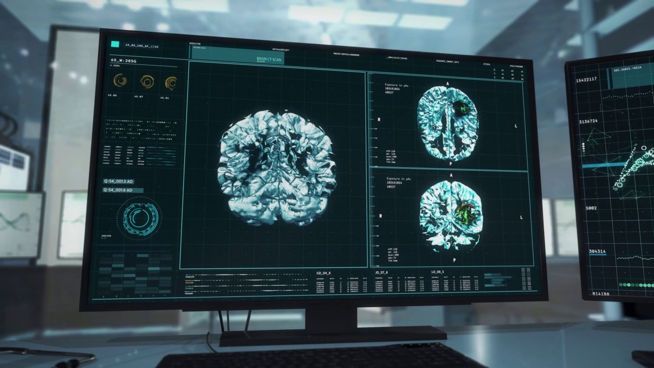 肿瘤诊断扫描正在检查大脑中的肿瘤视频素材