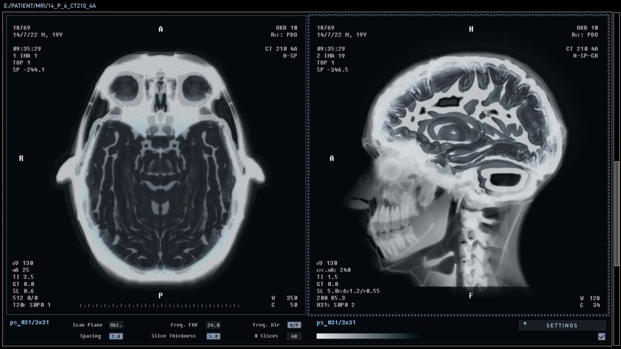 现代x光机扫描人类头骨检查大脑器官损伤视频素材