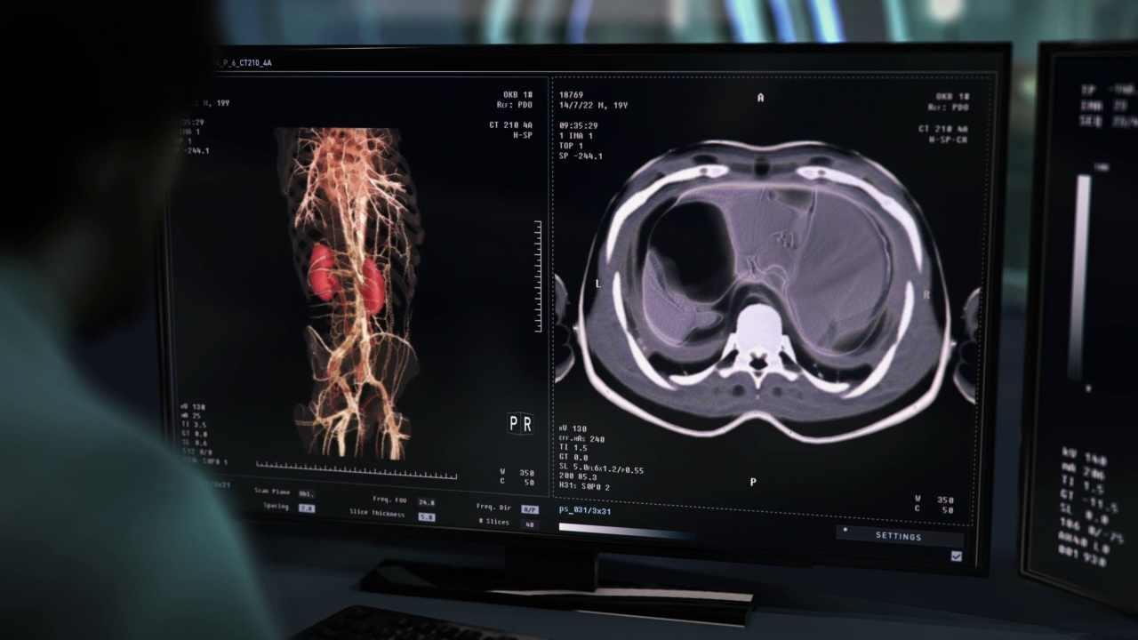 医生用于检查肾脏的现代x射线疾病诊断软件视频素材