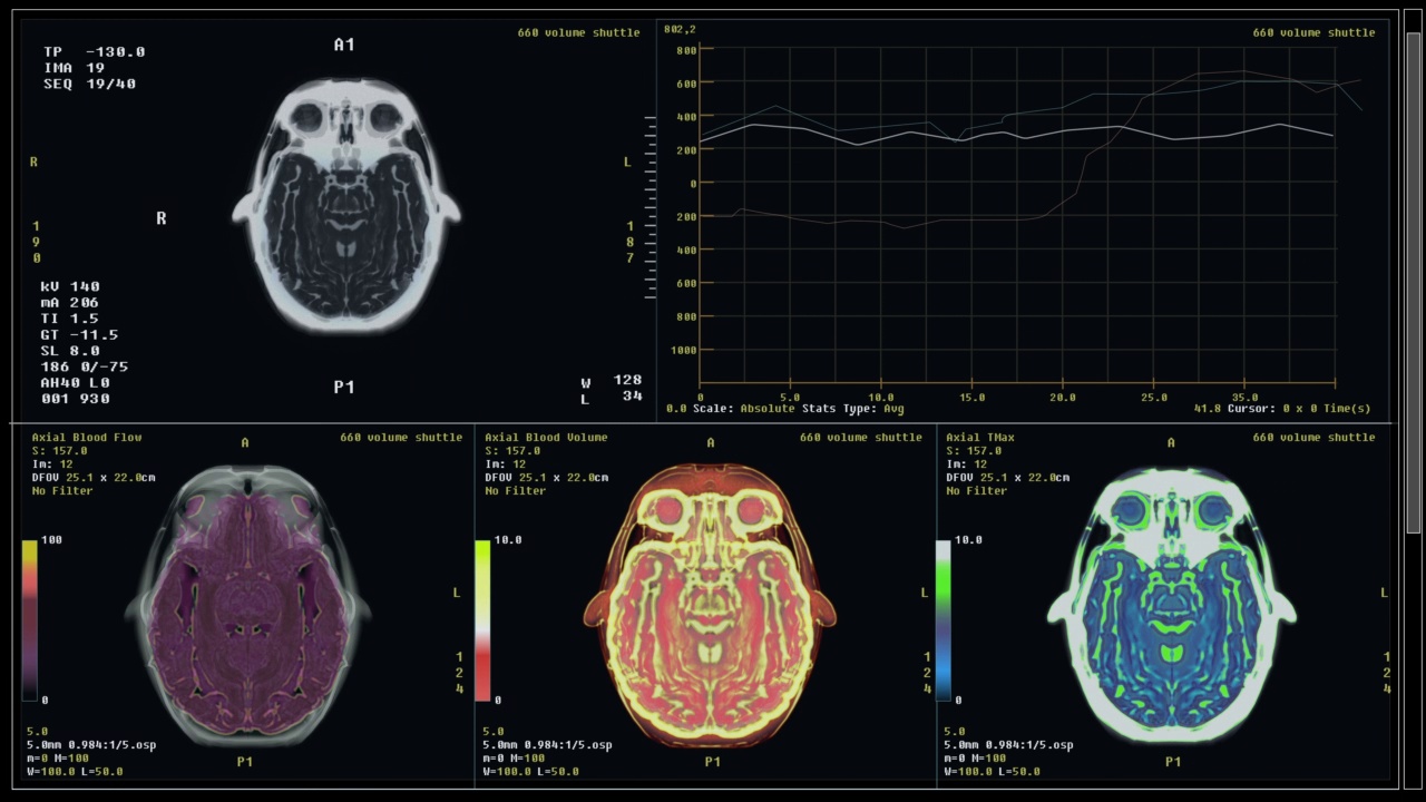 用医疗设备扫描病人脑部以诊断癌症视频素材