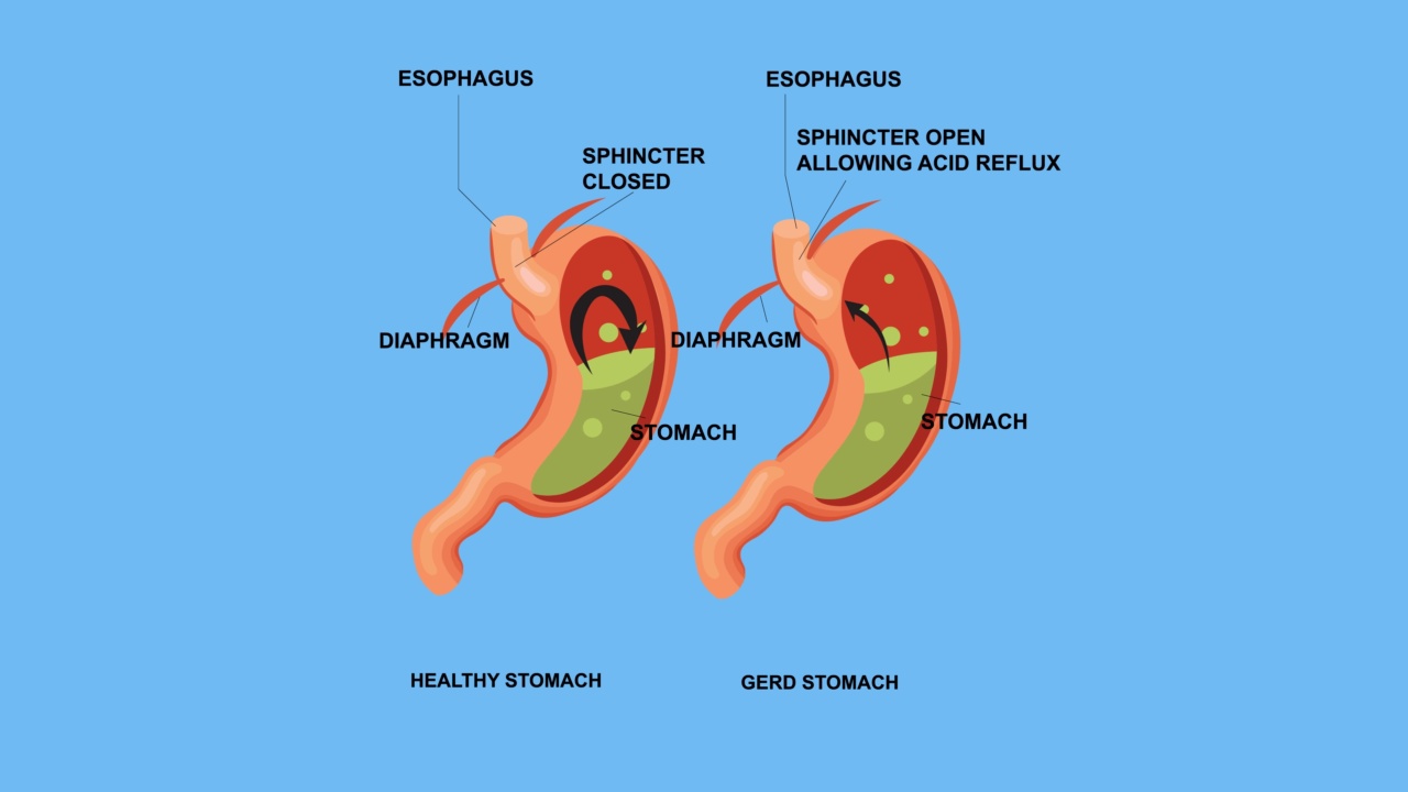 健康胃与反流胃的比较视频素材