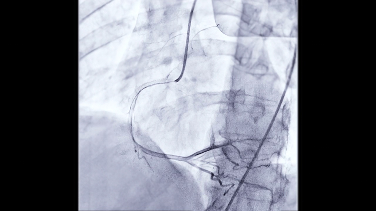 冠状动脉造影。视频素材