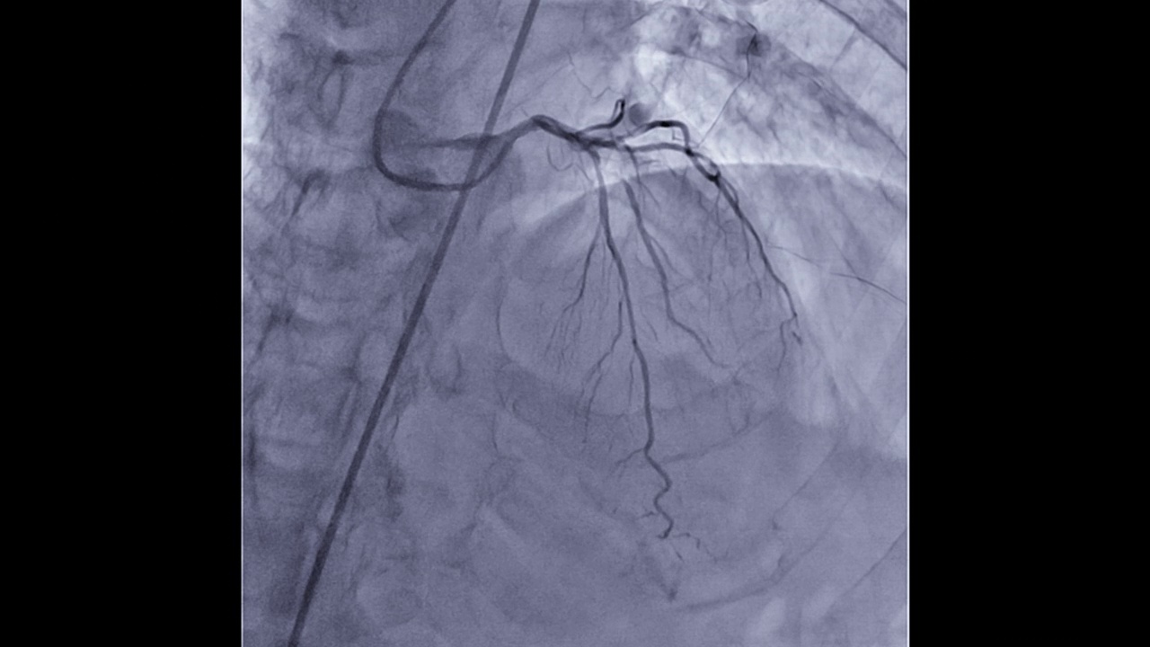 冠状动脉造影。视频素材