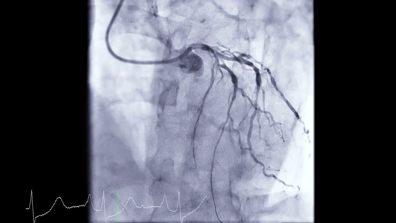 冠状动脉造影。视频素材