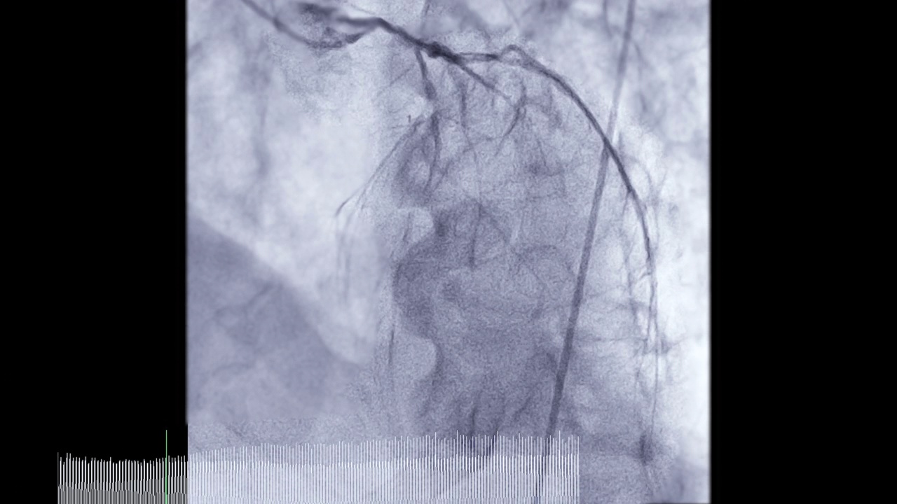 冠状动脉造影。视频素材