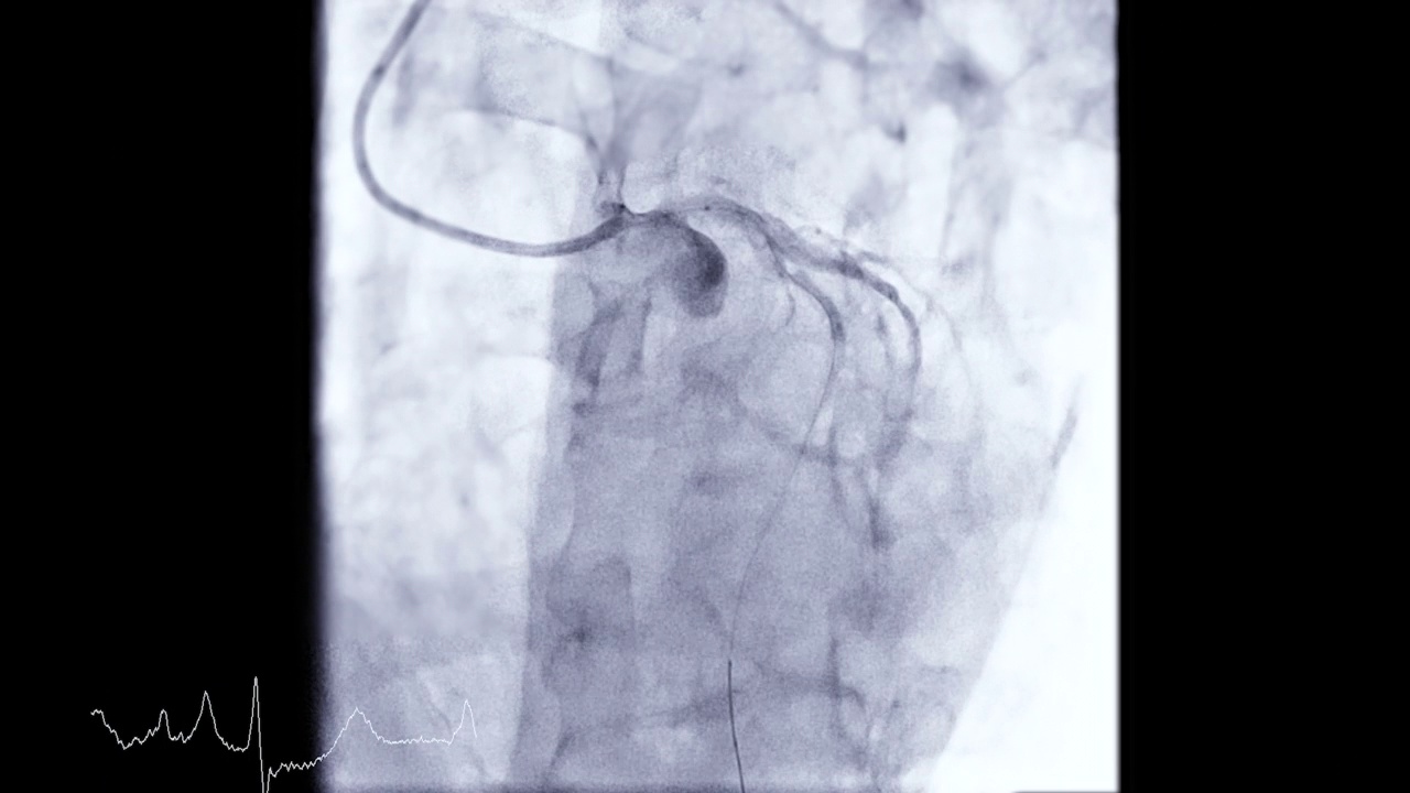 冠状动脉造影。视频素材