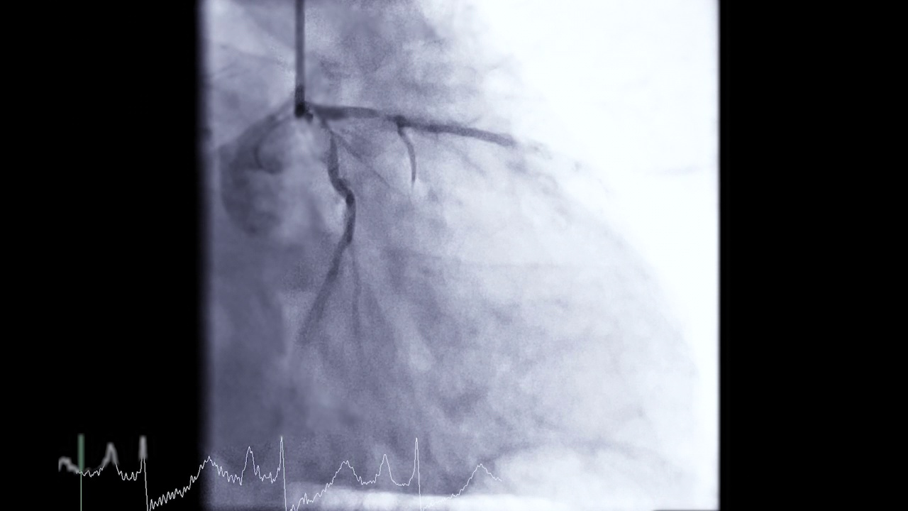 冠状动脉造影。视频素材