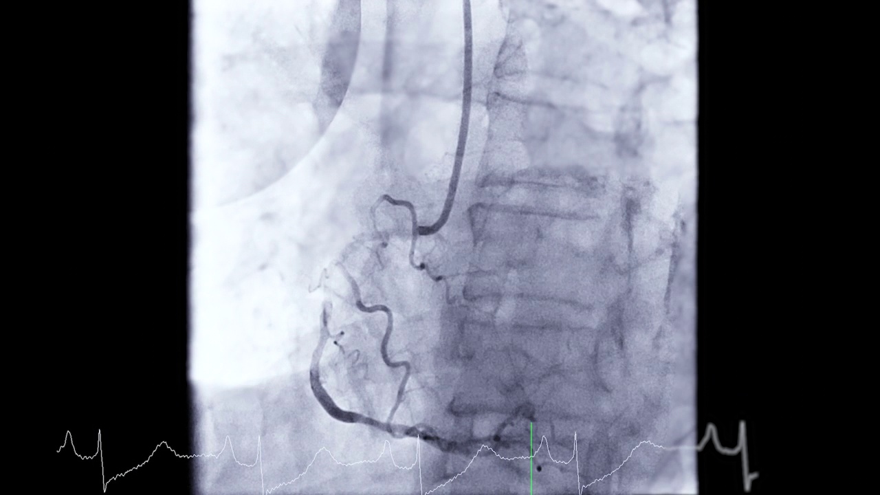 冠状动脉造影。视频素材