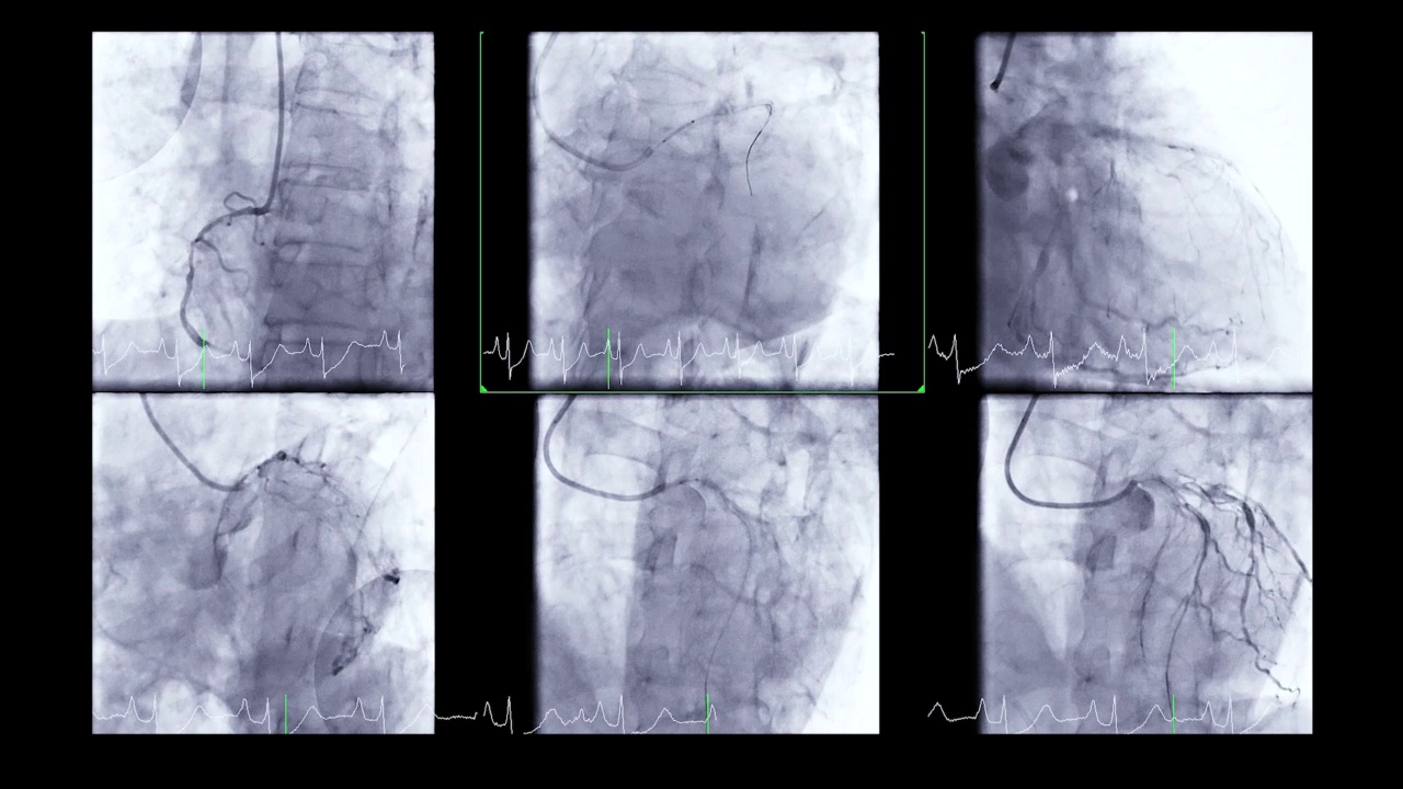 冠状动脉造影。视频素材