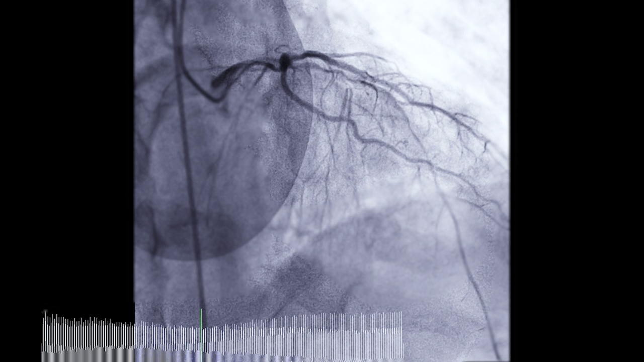 冠状动脉造影。视频素材