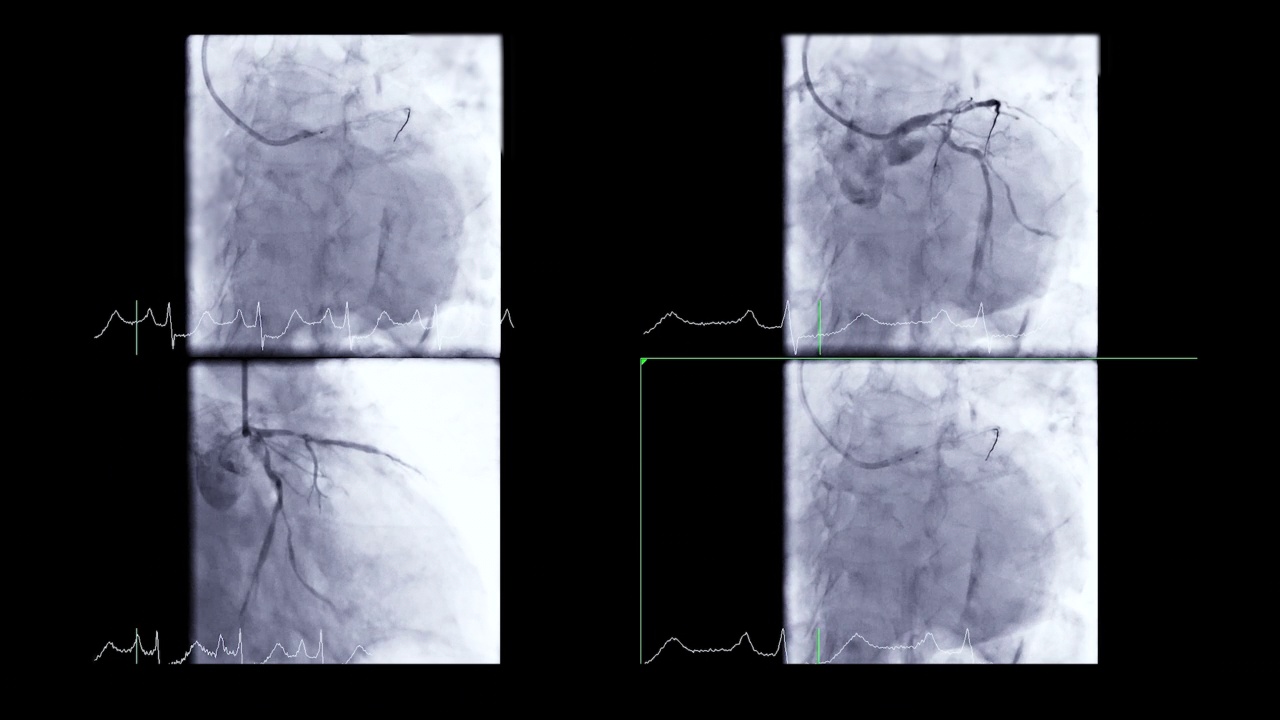冠状动脉造影视频素材