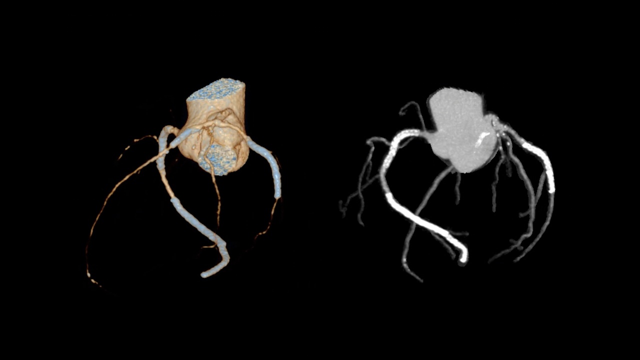 CTA冠状动脉三维绘制。视频素材