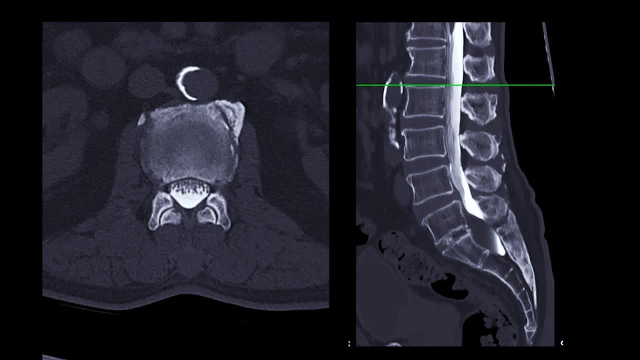 CT脊髓造影术视频素材